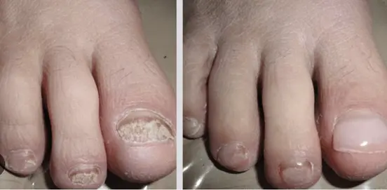 Benefits of Nail Refresh